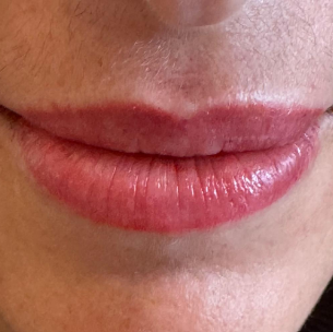 Pigmentation lèvres après