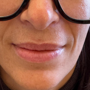 Pigmentation lèvres avant