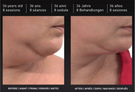 traitement affinant